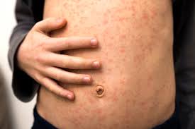 No measles cases reported in Ottawa County; health official urges vaccinations